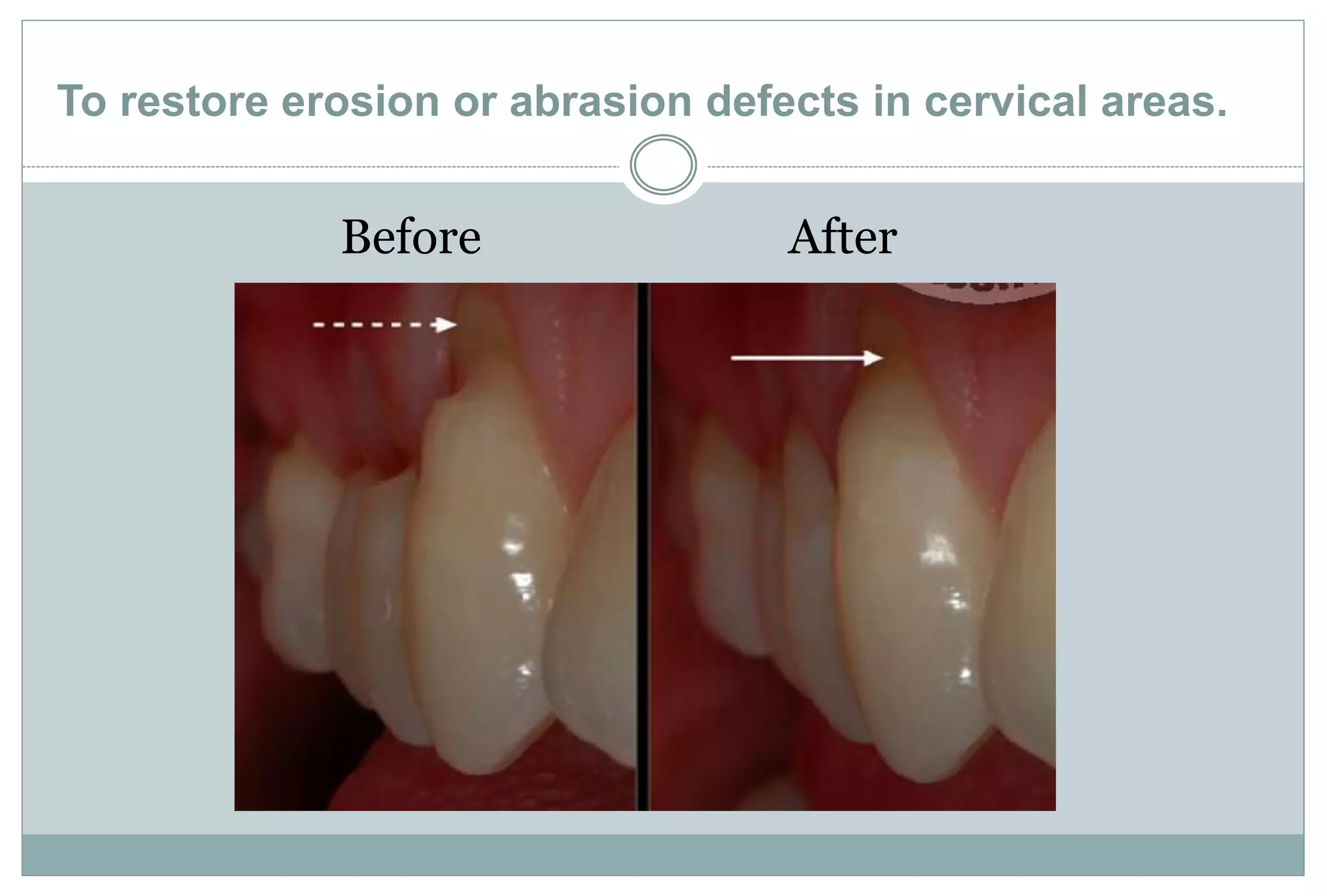 Adhesion and Dentin Bonding agent | PDF
