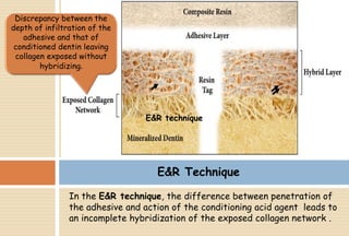 In the E&R technique, the difference between penetration of
the adhesive and action of the conditioning acid agent leads to
an incomplete hybridization of the exposed collagen network .
Discrepancy between the
depth of infiltration of the
adhesive and that of
conditioned dentin leaving
collagen exposed without
hybridizing.
E&R technique
E&R Technique
 