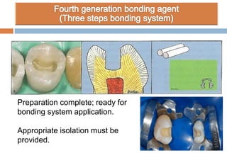 Preparation complete; ready for
bonding system application.
Appropriate isolation must be
provided.
 