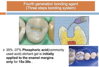  35% -37% Phosphoric acid(commonly
used acid) etchant gel is initially
applied to the enamel margins
only for 15s-30s .
 