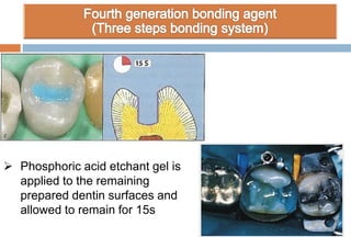  Phosphoric acid etchant gel is
applied to the remaining
prepared dentin surfaces and
allowed to remain for 15s
 