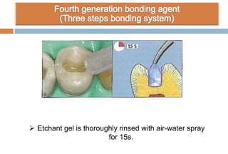  Etchant gel is thoroughly rinsed with air-water spray
for 15s.
 
