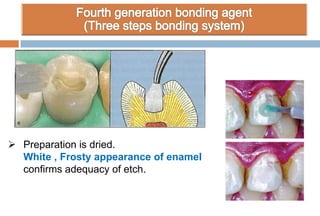  Preparation is dried.
White , Frosty appearance of enamel
confirms adequacy of etch.
 