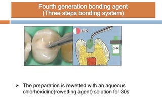  The preparation is rewetted with an aqueous
chlorhexidine(rewetting agent) solution for 30s
 