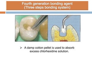  A damp cotton pellet is used to absorb
excess chlorhexidine solution.
 