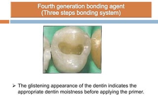 The glistening appearance of the dentin indicates the
appropriate dentin moistness before applying the primer.
 
