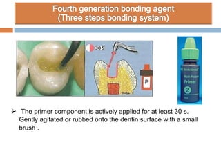  The primer component is actively applied for at least 30 s.
Gently agitated or rubbed onto the dentin surface with a small
brush .
 