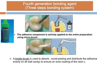  The adhesive component is actively applied to the entire preparation
using micro-brush .
 A bristle brush is used to absorb , avoid pooling and distribute the adhesive
evenly on all wall cavity( to ensure an even coating of the resin ).
 
