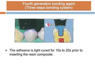  The adhesive is light cured for 10s to 20s prior to
inserting the resin composite .
 