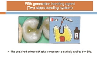  The combined primer adhesive component is actively applied for 30s.
 