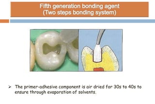  The primer-adhesive component is air dried for 30s to 40s to
ensure through evaporation of solvents.
 