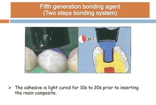  The adhesive is light cured for 10s to 20s prior to inserting
the resin composite.
 