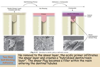No removal to the smear layer, the acidic primer infiltrates
the smear layer and creates a ”hybridized dentin/resin
layer”. The smear Plug becomes a filler within the resin
entering the dentinal tubules.
Two Step
Self-Etching
Adhesive
 