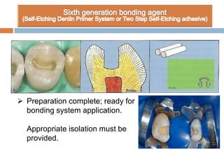  Preparation complete; ready for
bonding system application.
Appropriate isolation must be
provided.
 