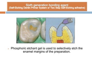  Phosphoric etchant gel is used to selectively etch the
enamel margins of the preparation.
 
