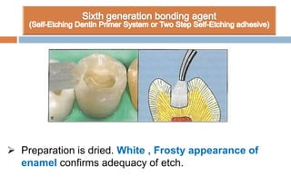  Preparation is dried. White , Frosty appearance of
enamel confirms adequacy of etch.
 