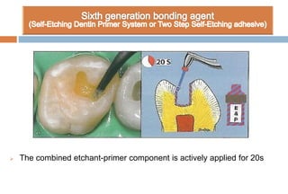  The combined etchant-primer component is actively applied for 20s
 