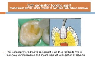  The etchant-primer adhesive component is air dried for 30s to 40s to
terminate etching reaction and ensure thorough evaporation of solvents.
 