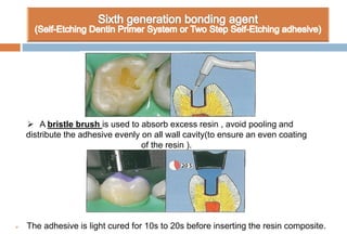  The adhesive is light cured for 10s to 20s before inserting the resin composite.
 A bristle brush is used to absorb excess resin , avoid pooling and
distribute the adhesive evenly on all wall cavity(to ensure an even coating
of the resin ).
 