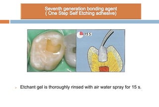  Etchant gel is thoroughly rinsed with air water spray for 15 s.
 