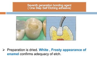  Preparation is dried. White , Frosty appearance of
enamel confirms adequacy of etch.
 