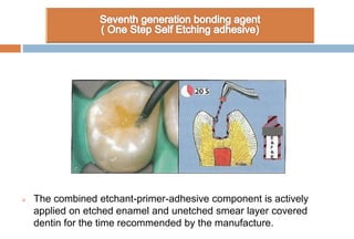  The combined etchant-primer-adhesive component is actively
applied on etched enamel and unetched smear layer covered
dentin for the time recommended by the manufacture.
 