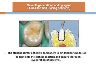  The etchant-primer-adhesive component is air dried for 30s to 40s
to terminate the etching reaction and ensure thorough
evaporation of solvents .
 