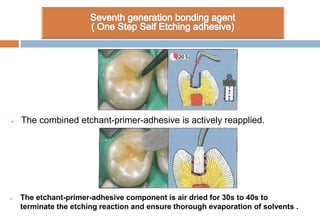  The combined etchant-primer-adhesive is actively reapplied.
 The etchant-primer-adhesive component is air dried for 30s to 40s to
terminate the etching reaction and ensure thorough evaporation of solvents .
 