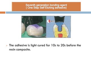  The adhesive is light cured for 10s to 20s before the
resin composite.
 