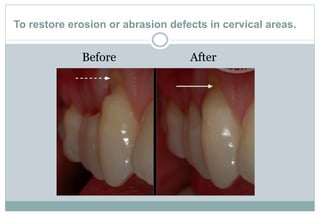 To restore erosion or abrasion defects in cervical areas.
Before After
 