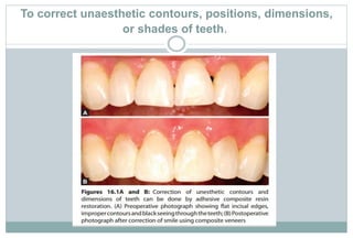 To correct unaesthetic contours, positions, dimensions,
or shades of teeth.
 