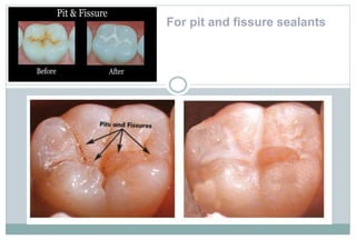 For pit and fissure sealants
 