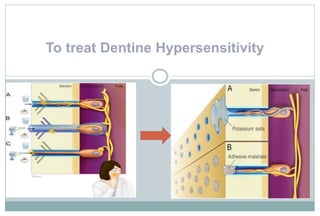 To treat Dentine Hypersensitivity
 