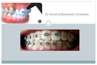 To bond orthodontic brackets
 