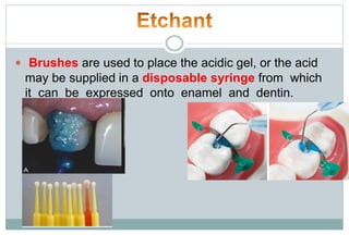  Brushes are used to place the acidic gel, or the acid
may be supplied in a disposable syringe from which
it can be expressed onto enamel and dentin.
 