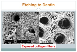 Exposed collagen fibers
 