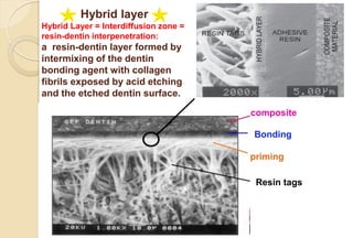 Hybrid layer
Hybrid Layer = Interdiffusion zone =
resin-dentin interpenetration:
a resin-dentin layer formed by
intermixing of the dentin
bonding agent with collagen
fibrils exposed by acid etching
and the etched dentin surface.
composite
Resin tags
priming
Bonding
 