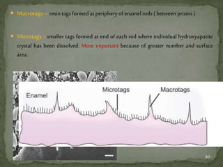  Macrotags–resin tags formed at periphery of enamelrods (between prisms )
 Microtags - smaller tags formed at end of each rod where individual hydroxyapatite
crystal has been dissolved. More important because of greater number and surface
area.
20
 
