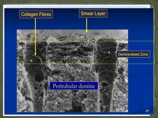  By etching dentin, the smear layer and minerals from it are removed,
exposingthecollagenfibers(&demineralizeddentin).
 Areasfromwheremineralsareremovedare filledwithwater.
 This water acts as a plasticizer for collagen, keeping it in an expanded soft
state.Thus,spacesforresininfiltrationare alsomaintained.
 But these collagen fibers collapse when dry. This prevents the resin
penetrationandhybridlayerformation.
46
 