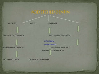 AIR DRIED MOIST OVERWET
COLLAPSE OF COLLAGEN SWELLING OF COLLAGEN
NO RESIN PENETRATION LESSER SPACE AVAILABLE
FOR RESIN PENETRATION
NO HYBRIDLAYER OPTIMAL HYBRIDLAYER
58
COLLAGEN
MAINTAINED
 