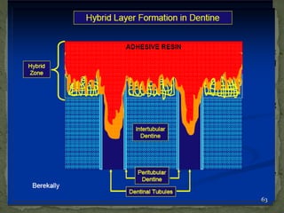  Zone where the adhesive resin of the dentin bonding agent
micromechanically interlocks within the intertubular dentin and
surrounding collagen fibres. Formed in the following manner:
A) Etching removes the smear layer & minerals (hydroxyapatite) exposing
the collagen fibrils & demineralized dentin.
B) Primers penetrate collagen network & demineralized dentine.
C) Along with the primers, adhesive resins form resin microtags within the
intertubular dentin andsurround the collagen fibres upon curing.
63
 