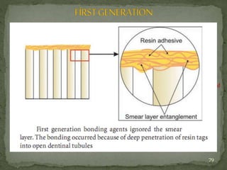  Developed in 1960s.
 First generation adhesives started with the development of NPG-GMA (Comonomer).
 It chelates with the Ca of the dentin and form a water –resistant chemical bond.
 When nuclear magnetic resonance analysis was done, it was found that no ionic bond
exist between NPG-GMA &hydroxyapatite(Ca).
 Low bond strength (2–3 MPa).
 Tradename: Cervident
79
 