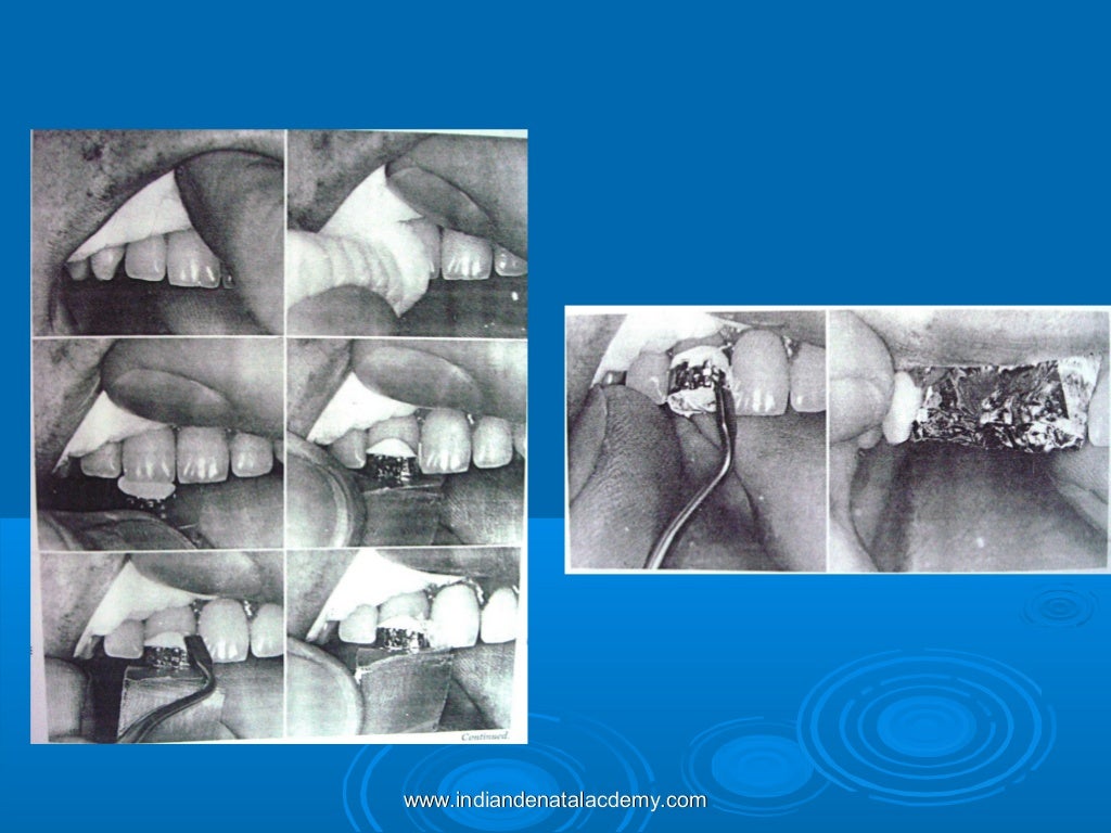 Bonding and banding in orthodontics / dental implant courses by Indi…