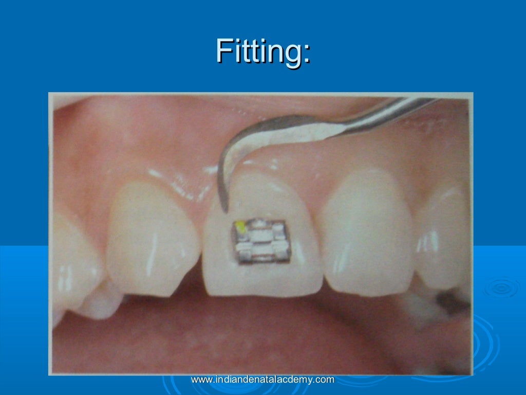 Bonding and banding................/certified fixed orthodontic cours…