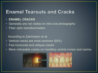 • ENAMEL CRACKS
• Generally are not visible on intra oral photographs
• Fiber optic transillumination
According to Zachrisson et al,
• Vertical cracks are most common (50%)
• Few horizontal and oblique cracks
• More noticeable cracks on maxillary central incisor and canine
 