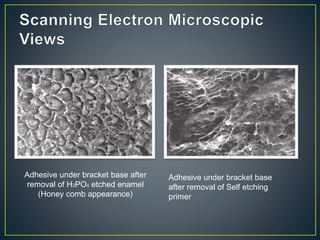 Adhesive under bracket base after
removal of H3PO4 etched enamel
(Honey comb appearance)
Adhesive under bracket base
after removal of Self etching
primer
 