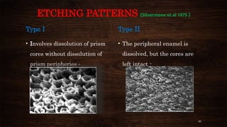 26
ETCHING PATTERNS (Silverstone et al 1975 )
Type I
• Involves dissolution of prism
cores without dissolution of
prism peripheries -
HONEY COMB
Type II
• The peripheral enamel is
dissolved, but the cores are
left intact -
COBBLESTONE
 