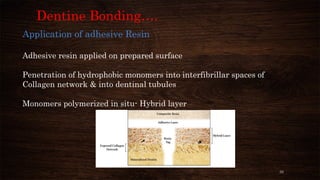 33
Dentine Bonding….
Application of adhesive Resin
Adhesive resin applied on prepared surface
Penetration of hydrophobic monomers into interfibrillar spaces of
Collagen network & into dentinal tubules
Monomers polymerized in situ- Hybrid layer
 
