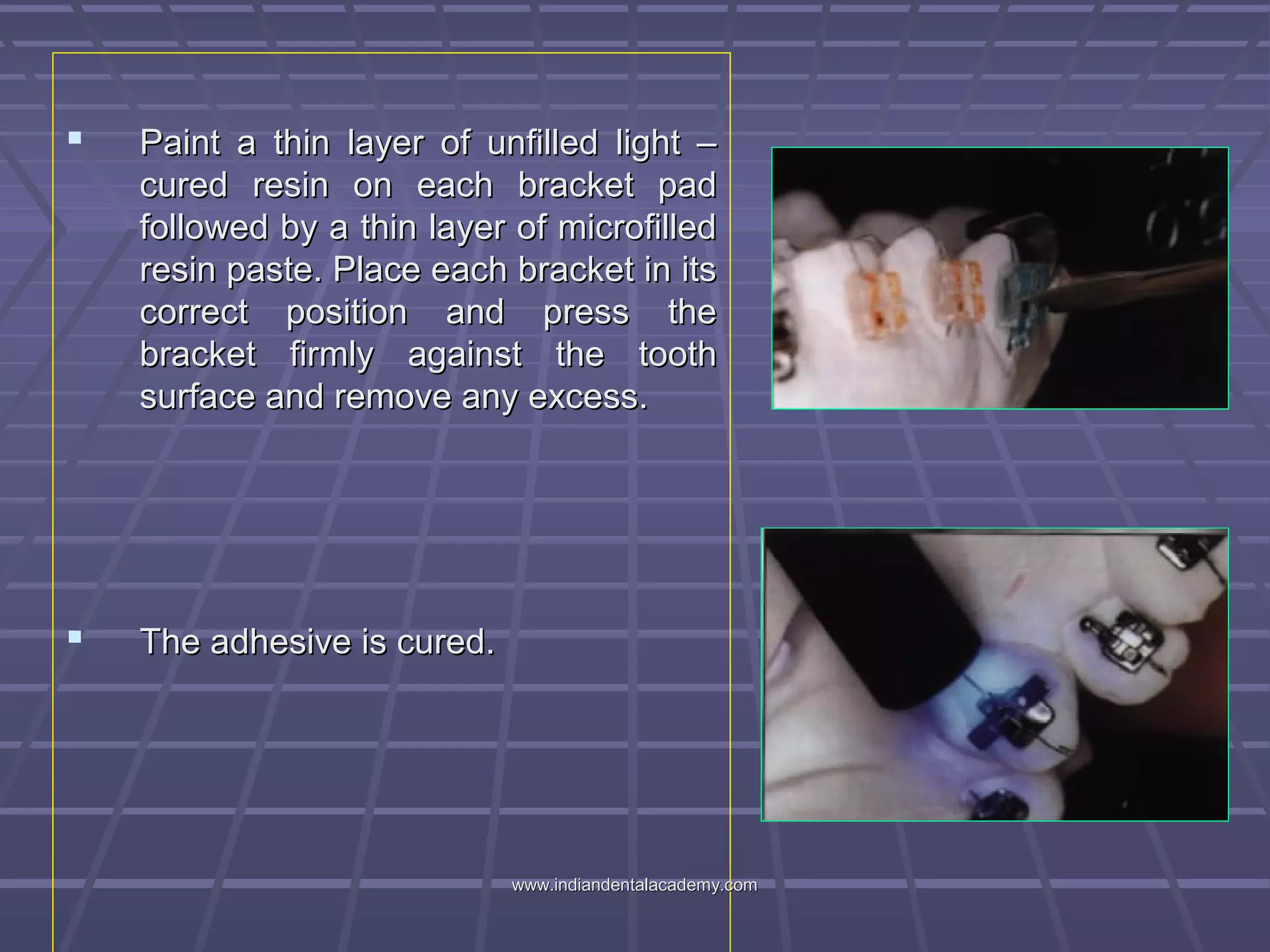  Paint a thin layer of unfilled light –Paint a thin layer of unfilled light –
cured resin on each bracket padcured resin on each bracket pad
followed by a thin layer of microfilledfollowed by a thin layer of microfilled
resin paste. Place each bracket in itsresin paste. Place each bracket in its
correct position and press thecorrect position and press the
bracket firmly against the toothbracket firmly against the tooth
surface and remove any excess.surface and remove any excess.
 The adhesive is cured.The adhesive is cured.
www.indiandentalacademy.comwww.indiandentalacademy.com
 