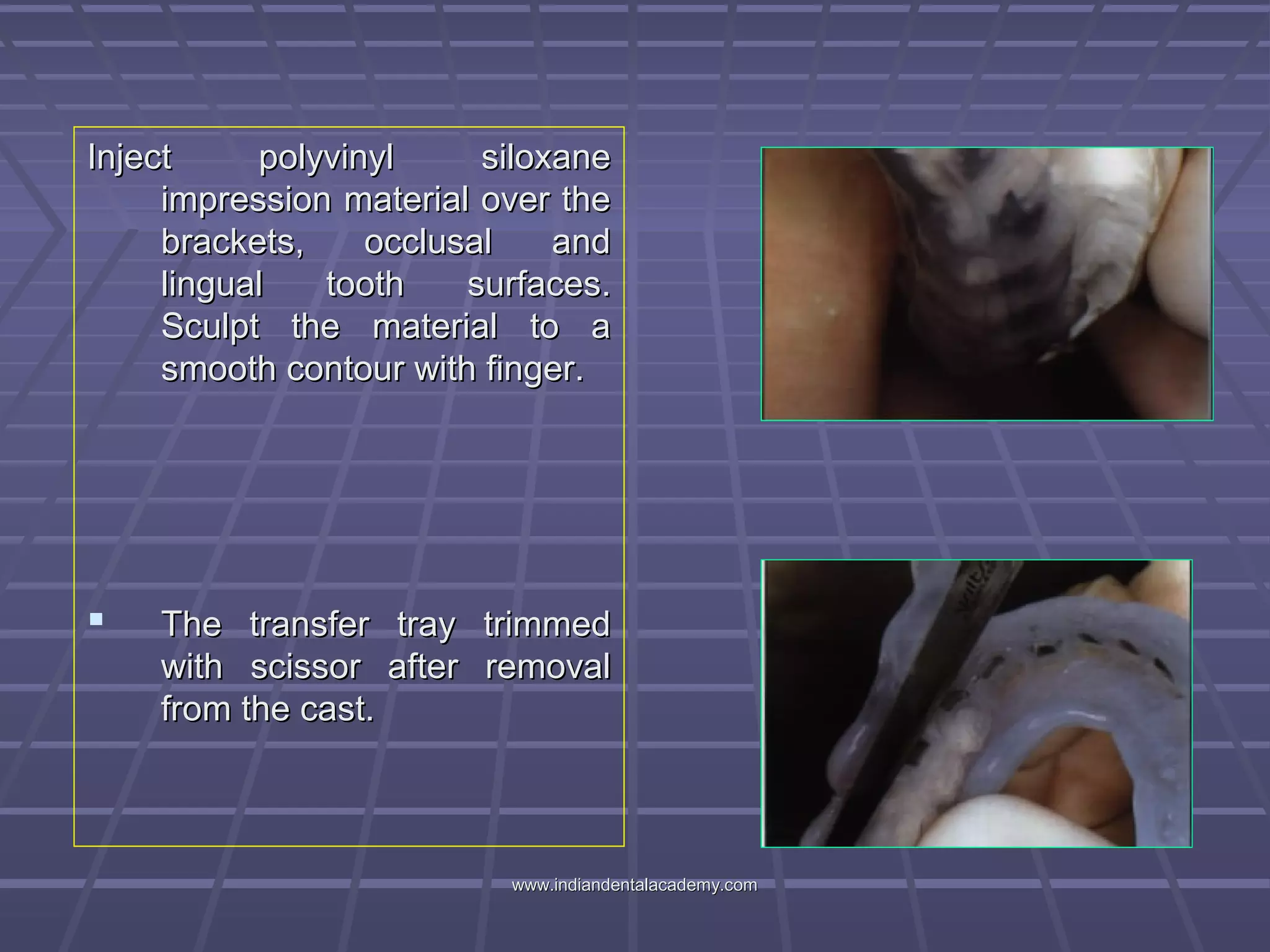 Inject polyvinyl siloxaneInject polyvinyl siloxane
impression material over theimpression material over the
brackets, occlusal andbrackets, occlusal and
lingual tooth surfaces.lingual tooth surfaces.
Sculpt the material to aSculpt the material to a
smooth contour with finger.smooth contour with finger.
 The transfer tray trimmedThe transfer tray trimmed
with scissor after removalwith scissor after removal
from the cast.from the cast.
www.indiandentalacademy.comwww.indiandentalacademy.com
 